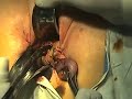 Vaginal hysterectomy New surgical technique UTERINE PROLAPSE 1