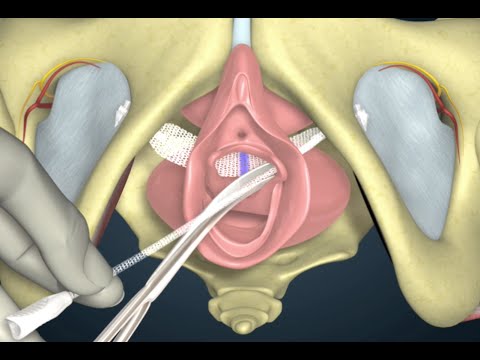 Urinary Incontinence: Vaginal Bladder Sling - YouTube
