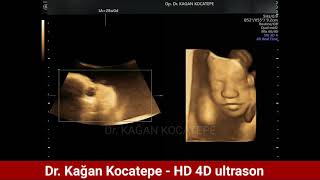 4 BOYUTLU VE HD ULTRASON NET GÖRÜNTÜLERİ - 28 HAFTALIK GEBELİK