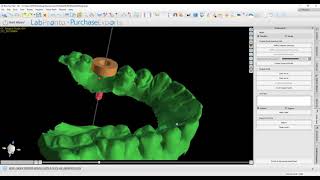 Path of Insertion to Remove Undercuts (BSP 4.8.2)