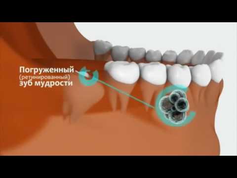 Как снять воспаление с зуба в домашних условиях Как снять воспаление с зуба в домашних условиях