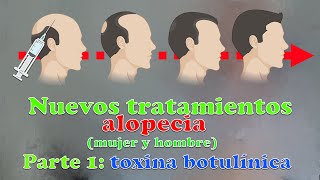 NUEVOS TRATAMIENTOS ALOPECIA: TOXINA BOTULÍNICA