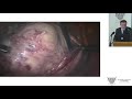 Chirurgie mini-invasive des myomes utérins : progrès et limites