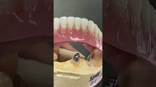 Locator Denture