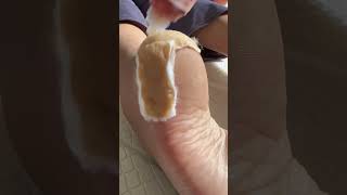 Obat Kaki Kapalan Dan Pecah Pecah Terajaib Sih Ini