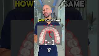 Correcting A Deep Bite Because Of Extruded Upper Front Teeth With Invisalign Treatment.