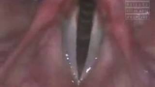 Psychogenic Aphonia - .Wohlt