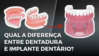 Qual a diferença entre dentadura e implante dentário?