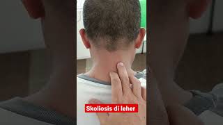 Contoh Kondisi Skoliosis Di Leher