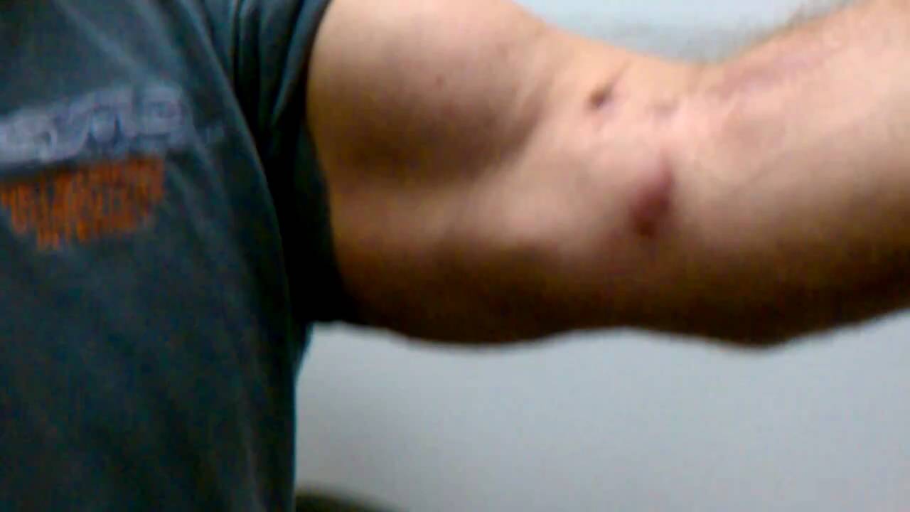 Left Distal Biceps Tendon Rupture complications? - YouTube