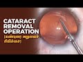 Cataract Removal Procedure - Cataract Operation (கண்புரை அறுவைச் சிகிச்சை செய்முறை )