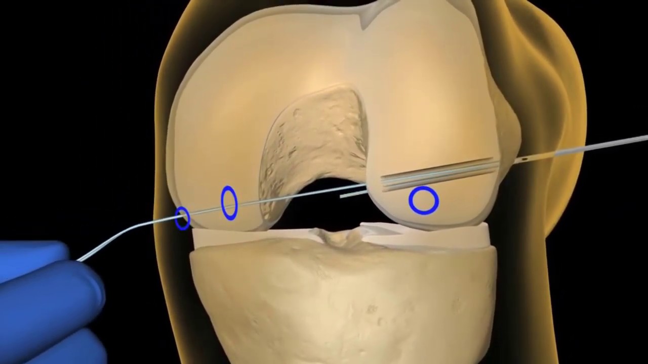 Vulva reconstruction surgery pictures