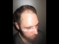 hair transplantation in India