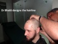 hair transplantation in India