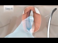 Mail Incontinence Sling AdvanceXP