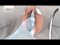 Mail Incontinence Sling AdvanceXP