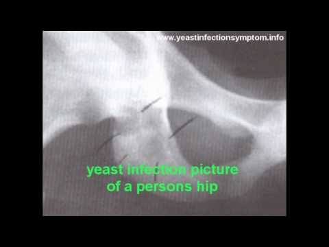 Children Yeast Infection