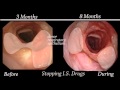 Endoscopic Evaluation of the Tracheal Allotransplant