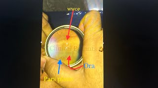 Ora Serrata Vs Lattice Degeneration