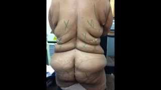 brazilian butt lift surgery video,butt augmentation,liposuction video,fat transfer,laser,smart lipo