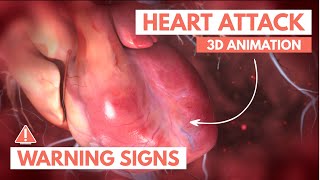 Watch 3 Heart Attack video
