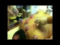 The Therapy Clinic, UK , Cupping/Blood Letting/Hijama treatment on Neck, Shoulders and Back. Part 1