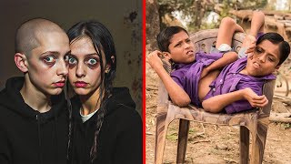 The Unseen World Of Siamese Twins Top 10 Most Extraordinary Cases
