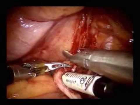 Header of cystectomy
