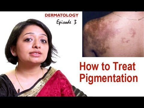 How to Treat Skin Pigmentation- Episode 3 - YouTube