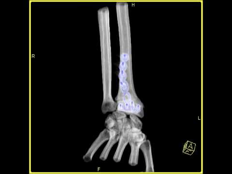 Nonunion distal radius