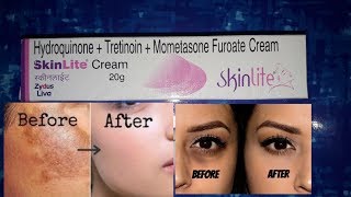 Skinlite cream review | uses | side effects | How to use |How it works |advise |cures brown patches