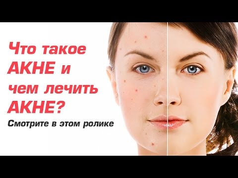 Всё что лечит акне Всё что лечит акне