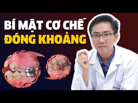 Nhổ Răng Khi Niềng | Bí Mật Cơ Chế Đóng Khoảng | Kiến Thức Nha Khoa
