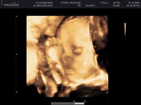 3D/4D Prenatal Ultrasound sonography test for pregnancy. 3D/4D Prenatal Ultrasound