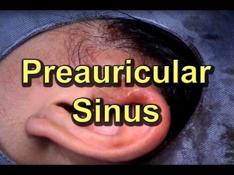 Preauricular Ear Sinus Infection - YouTube
