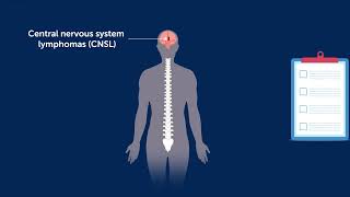 Profiling Circulating Tumor Dna To Monitor And Clify Brain Lymphomas