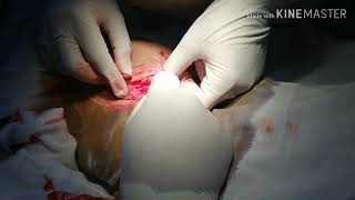 Open Appendectomy