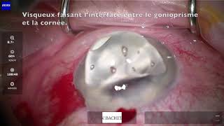 Chirurgie De La Cataracte Et Pose De Istent