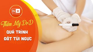 Thẩm Mỹ Drd Và Quá Trình Đặt Túi Ngực Nano Chip Kết Hợp Keo Dán Da Dermabond