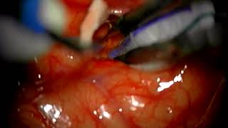 Caso De Paciente Con Tumor Cerebral Tipo Astrocitoma