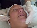 Tracey Bell - Microdermabrasion