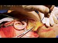 SMAS Facelift - Dr. Paul Ruff | West End Plastic Surgery
