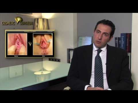 Hymenoplasty | Cosmetic V surgeon