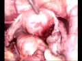 Laparoscopic surgery for an ectopic pregnancy Virgin Mary Hospital Bourgas city Bulgaria