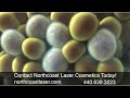 Coolsculpting Cleveland, Northcoast Laser Cosmetics
