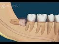 Wisdom Tooth Causing Swollen Gums/Pain | Implants Pro Center© | San Francisco