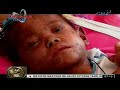 24 Oras: Bata, tila nasunog ang balat dahil sa malnutrisyon