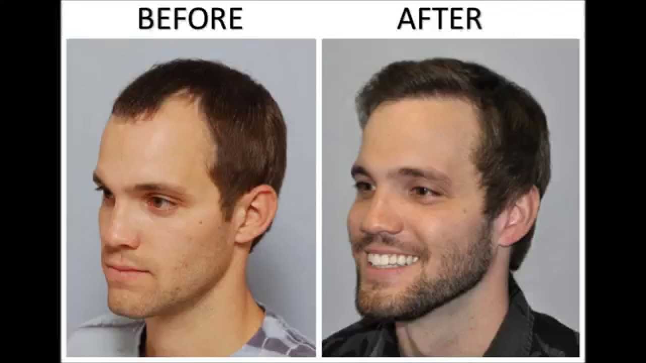 Medicines promote facial hair growth