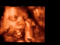 Ecografia 3D Angelica Francesca.wmv