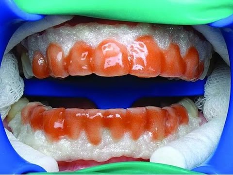 Посеребрили зубы как отбелить Посеребрили зубы как отбелить
